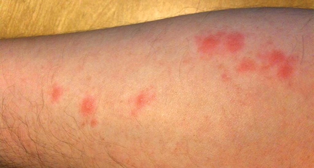 an arm with bed bug bites